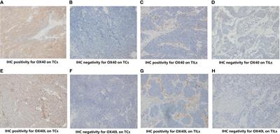 Immune Checkpoints OX40 and OX40L in Small-Cell Lung Cancer: Predict Prognosis and Modulate Immune Microenvironment